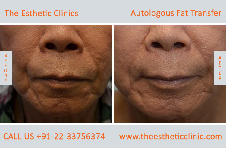 Autologous Fat Transfer, Fat Transfer Grafting, Lipofilling Fat Transfer Surgery before after photos (1